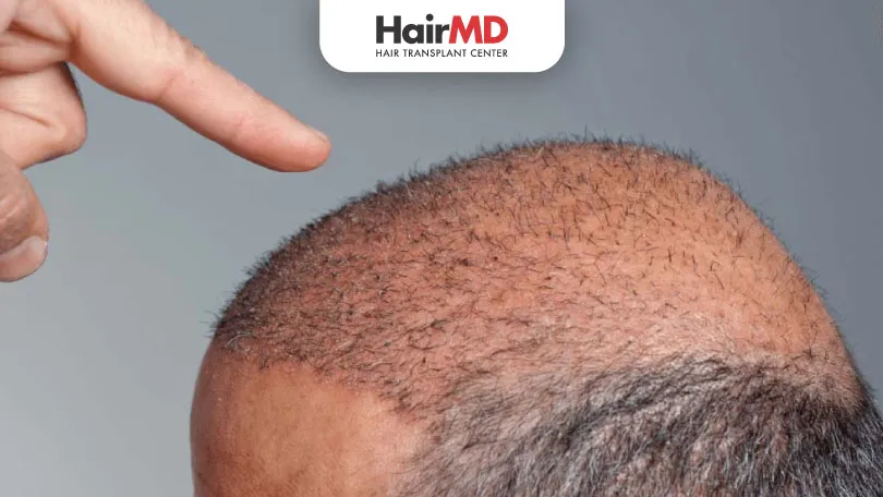 FUE Hair Transplant – Stages of Hair Regrowth