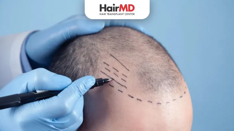 FUE Hair Transplant: The Most Popular Hair Transplant Method