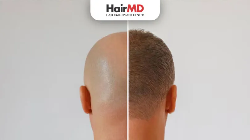 Hacks to get Nearly Permanent Hair Transplant: Expert Tips