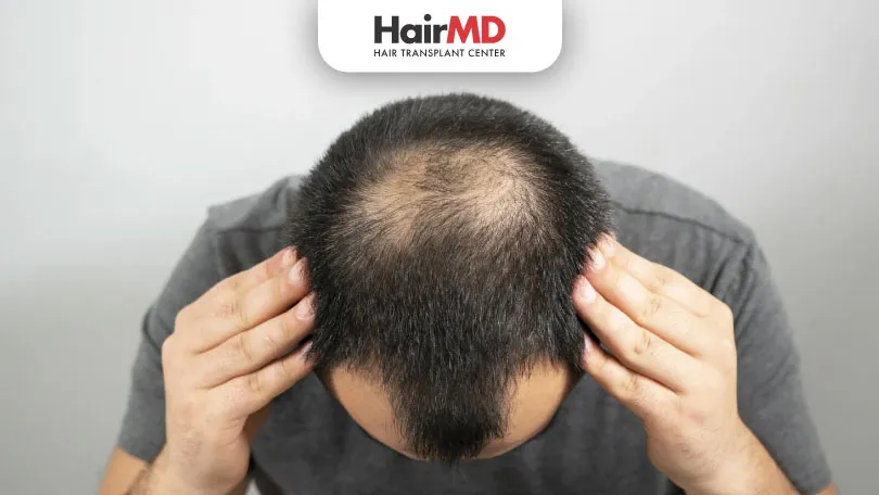 What is the Relationship Between Testosterone and Hair Loss?