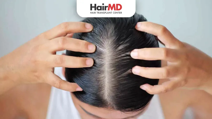 Hair Loss In Women Everything You Need To Know HairMD Pune