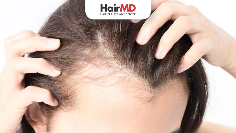 Understanding Female Pattern Baldness: Early Stage Causes and Solutions