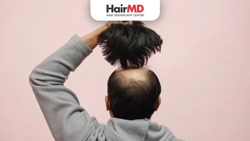 Hair Transplant or Hair Patching: Choosing the Right Solution for Baldness