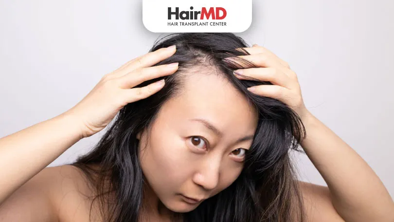 What Causes Hair Loss on Temples and How to Treat It