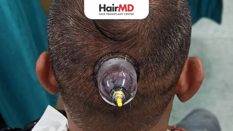 Hijama Therapy for Hair Loss: Effectiveness and Success Rate