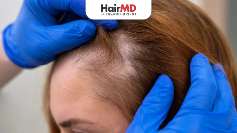 Understanding Hair Loss Diagnosis: How Dermatologists Assess It