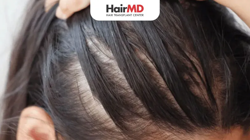 How are Estrogen Levels Responsible for Hair Loss HairMD Pune