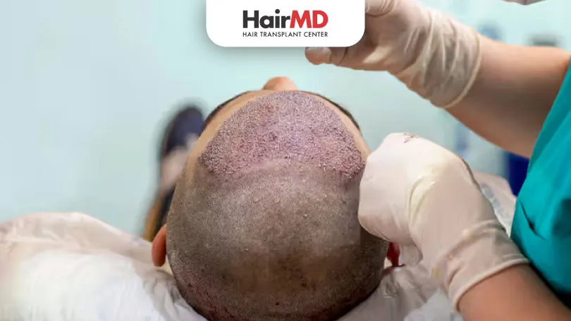 FUE Hair Transplant Without Shaving: Is It Possible?