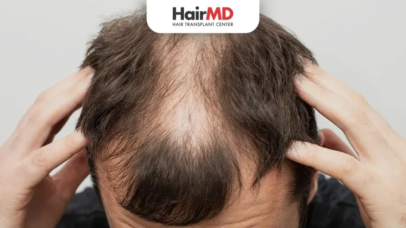 Hamilton Pattern Hair Loss: What You Need to Know