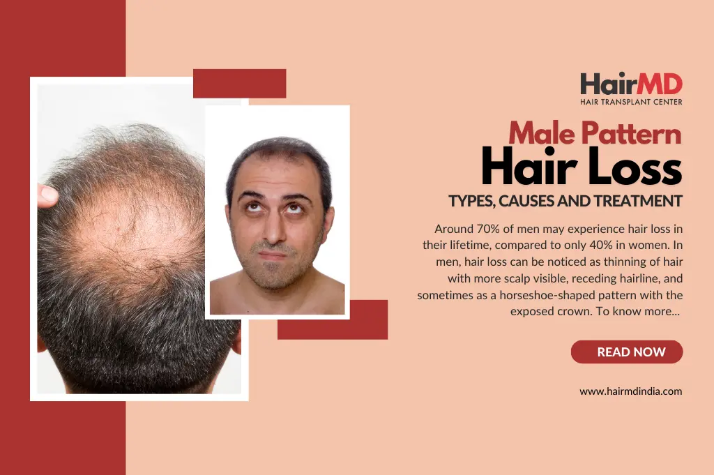 Male Pattern Baldness  Its Types  Treatment  Traya Health