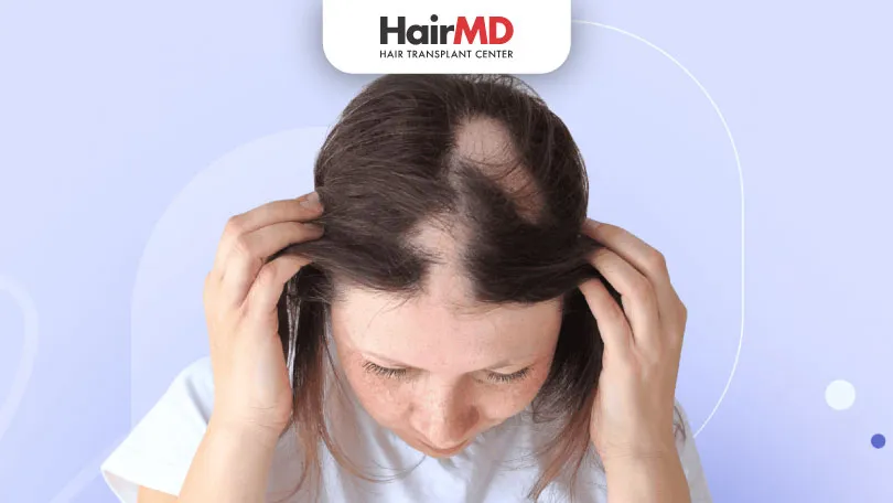 Alopecia Areata: Food Diet, Home Remedies And Treatments