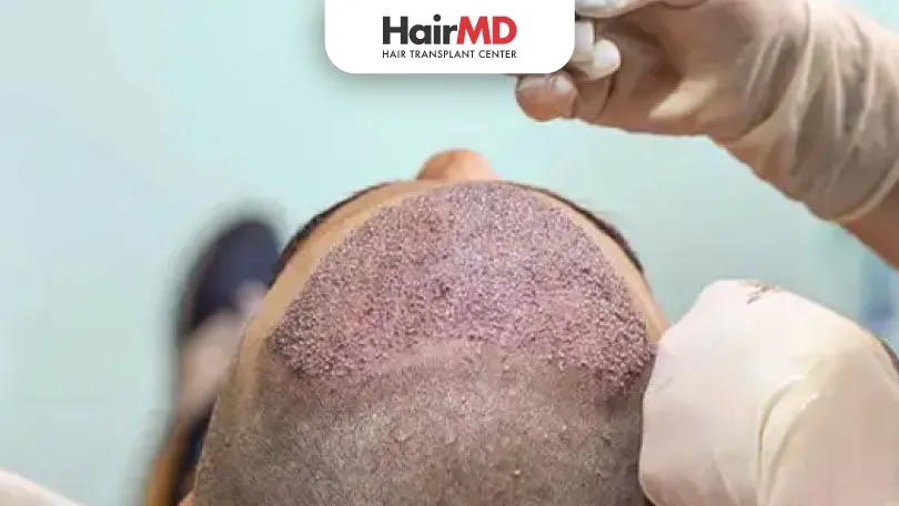 How to remove scabs after Hair Transplant? | HairMD