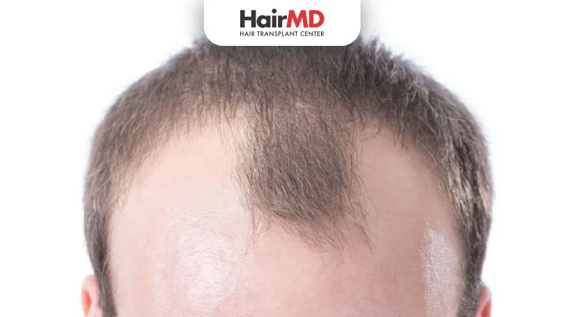 Stop Your Hairline from Receding: Effective Solutions & Prevention Tips