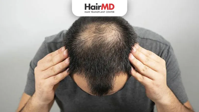 How to Reverse Male Pattern Baldness?