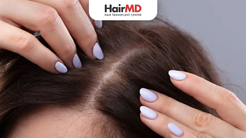 How to Stop Female Crown Hair Thinning?