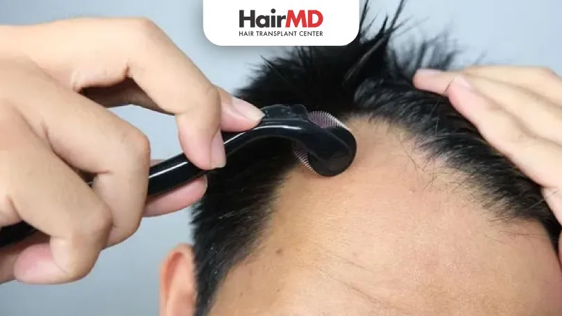 How to use Minoxidil and Dermaroller together?