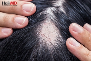 Alopecia Areata