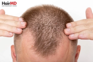 Eligibility for Hair Transplant 