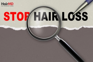 Hair Loss Treatments