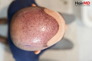 Hair Transplant