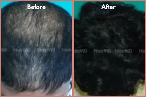 Hair transplant Before and After