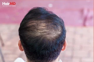 How Does Metoprolol Cause Hair Loss?