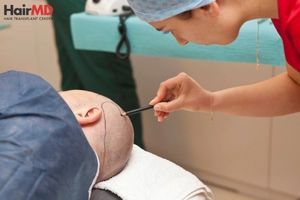 Is FUE hair transplant safe?