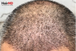 Is hair transplant safe?