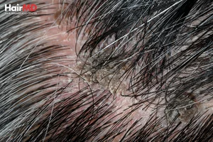 Medical Conditions or Hormonal Hair Loss