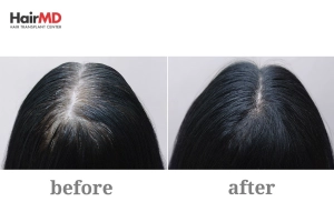 Success Rate of PRP Therapy for Hair Loss