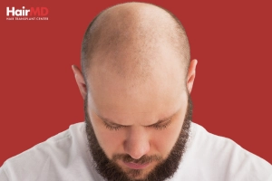 What is hair loss?