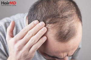 Symptoms of lupus hair loss