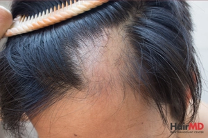 Genetic Hair Loss