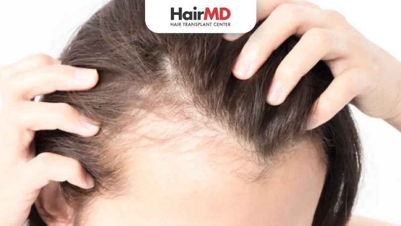 Regenera Activa Hair Loss Treatment: Cost and More