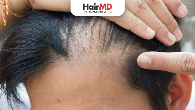 Itchy Scalp and Hair Loss: Causes, Treatments, and Prevention