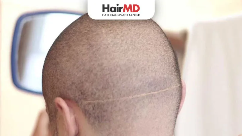 Are Hair Transplant Scar Visible?