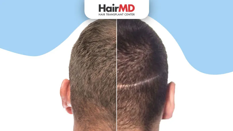 FUE vs FUT: Which one is a Best Method of Hair Transplant?