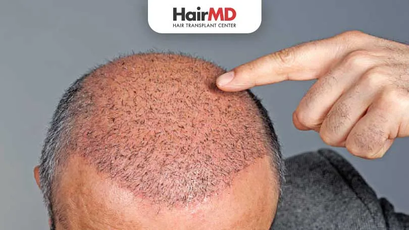 How Long Does it Take to Grow Hair After Hair Transplant?