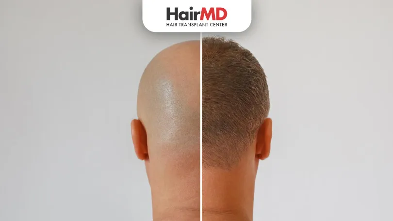 Is hair transplant successful in India?