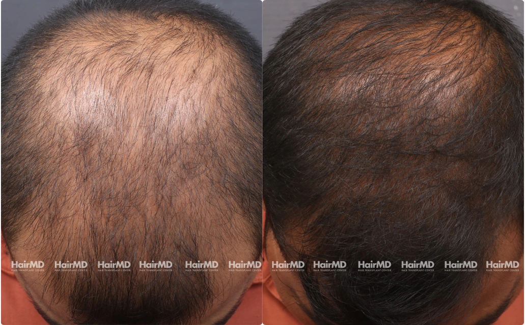 Male Hair Loss Results 7 Sessions 6 Months HairMD Pune 1