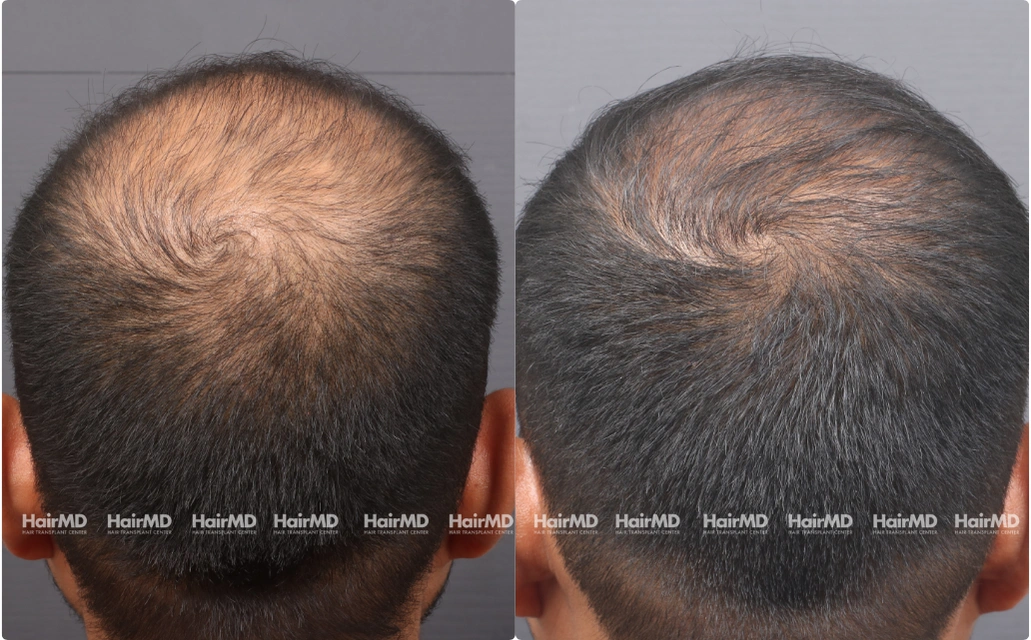 Male Hair Loss Results 7 Sessions 6 Months HairMD Pune 2