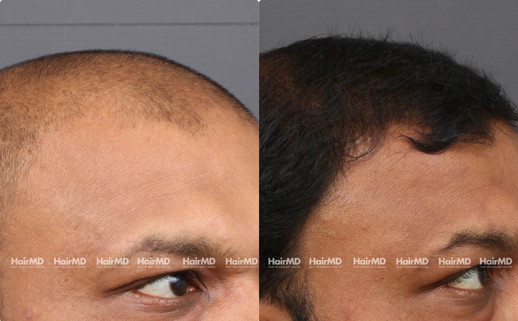 Male Hair Loss Results 7 Sessions 6 Months HairMD Pune 3