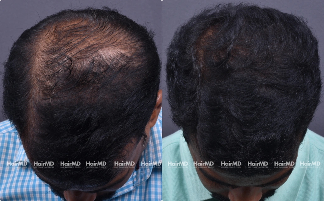 Male Hair Loss Results 7 Sessions 6 Months HairMD Pune 4