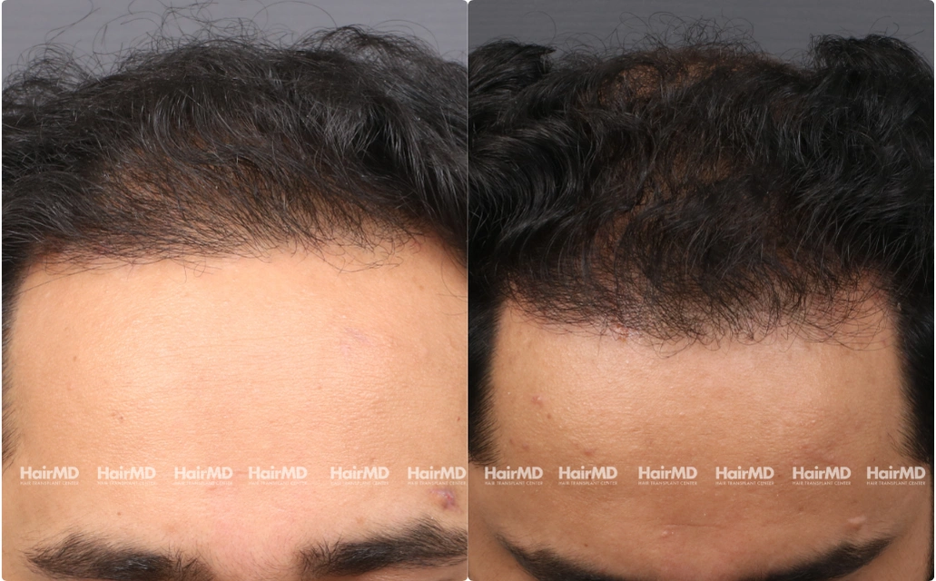 Male Hair Loss Results 7 Sessions 6 Months HairMD Pune 5