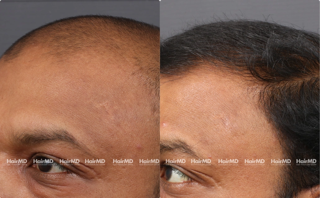 Male Hair Loss Results 7 Sessions 6 Months HairMD Pune