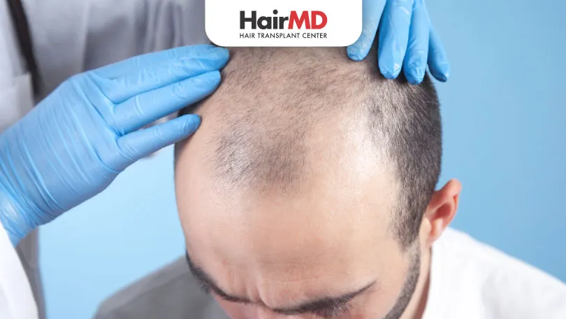 Do Vitamins Work for Hair Loss in Men? Key Vitamins for Treatment