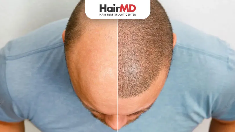 What is the cost for hair transplant in India?