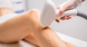 Diode Laser Hair Removal