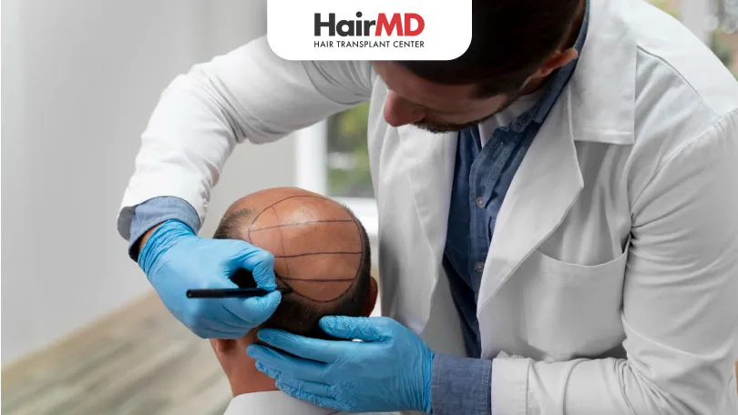 Understanding Hair Transplant Pricing in India