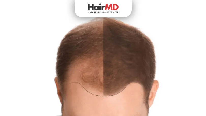 Post-FUE Hair Transplant: What You Need to Know